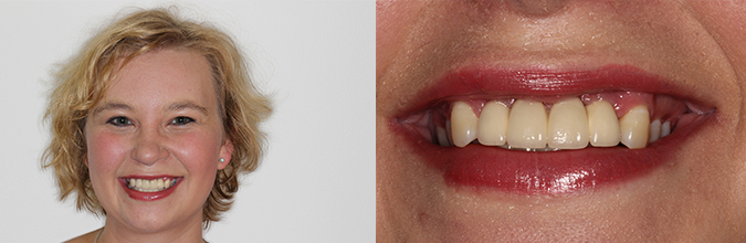 How Dr Joffe Helped a Patient with Diabetes Reclaim Her Smile