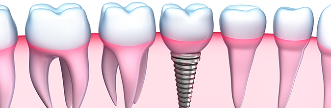 How to Restore Your Smile with Hyde Park Dental Care