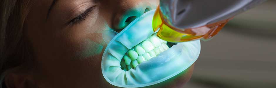 Teeth Whitening Makeovers