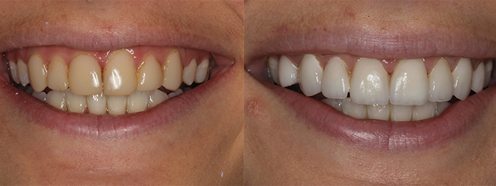 veneers close up