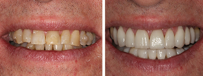 Before & After Dental Veneers