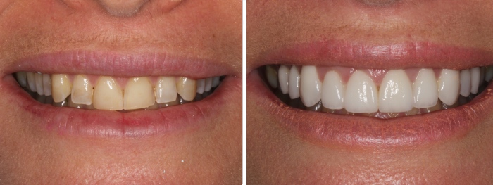 Veneers Sydney CBD