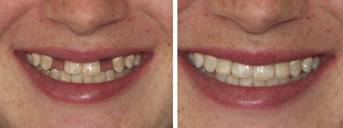 Before & After Dental Implants