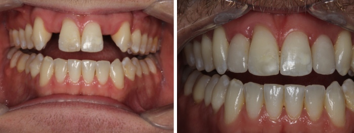 Dental Implant Insertion