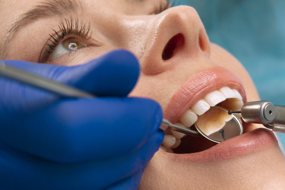 Which dental filling is best?